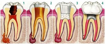 advanced root canal