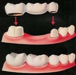 dental bridge