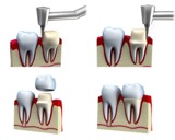 dental crown