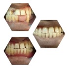 complete or partial dentures