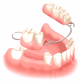 complete or partial dentures