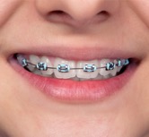 fixed braces