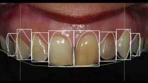 dental crown